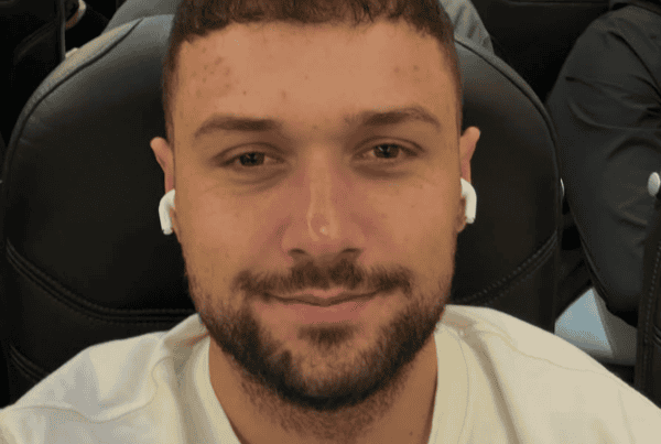 12 months after a hair transplant
