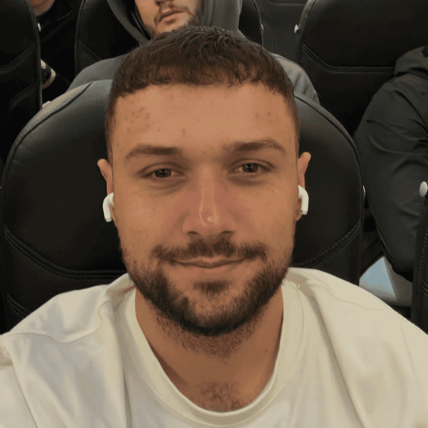 12 months after a hair transplant