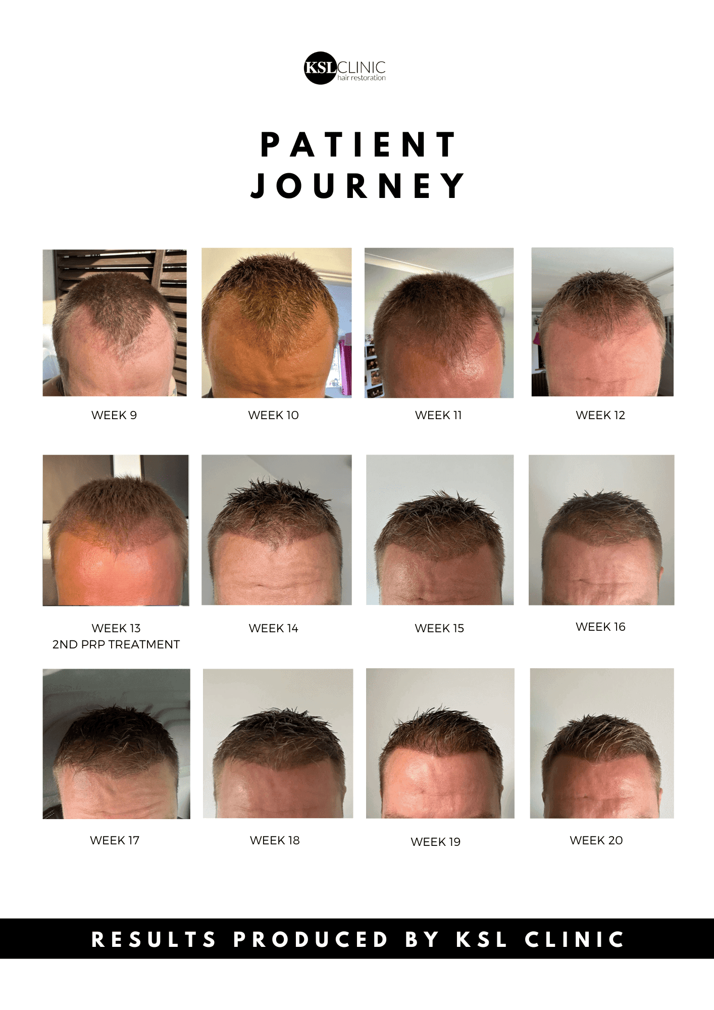 hair transplant week by week case study