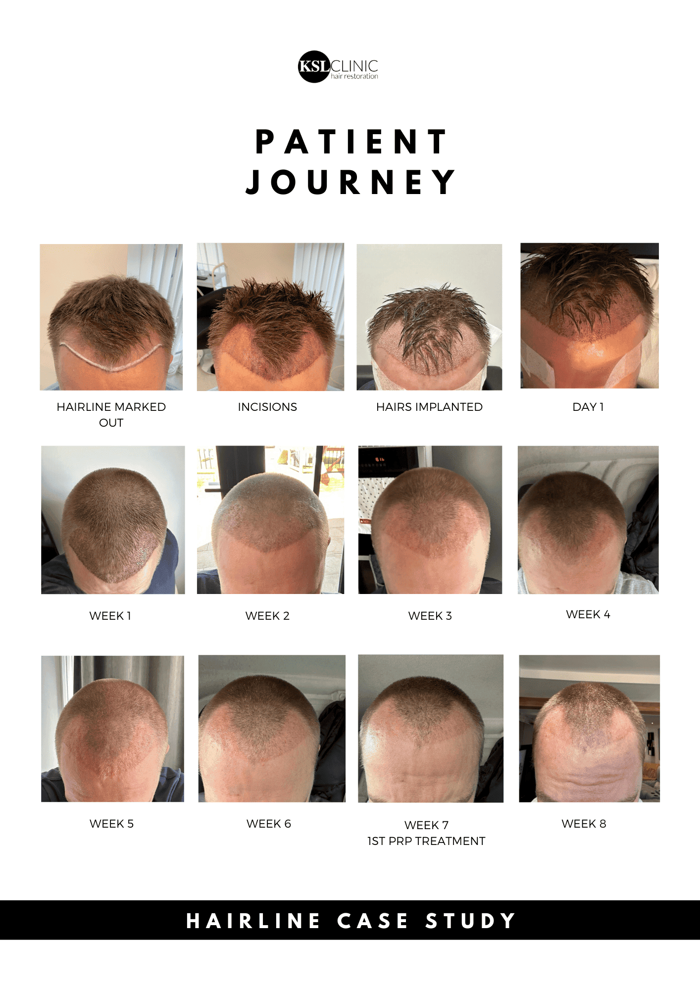 ksl real life example of hair transplant timeline