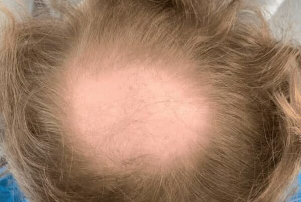 reasons for hair loss