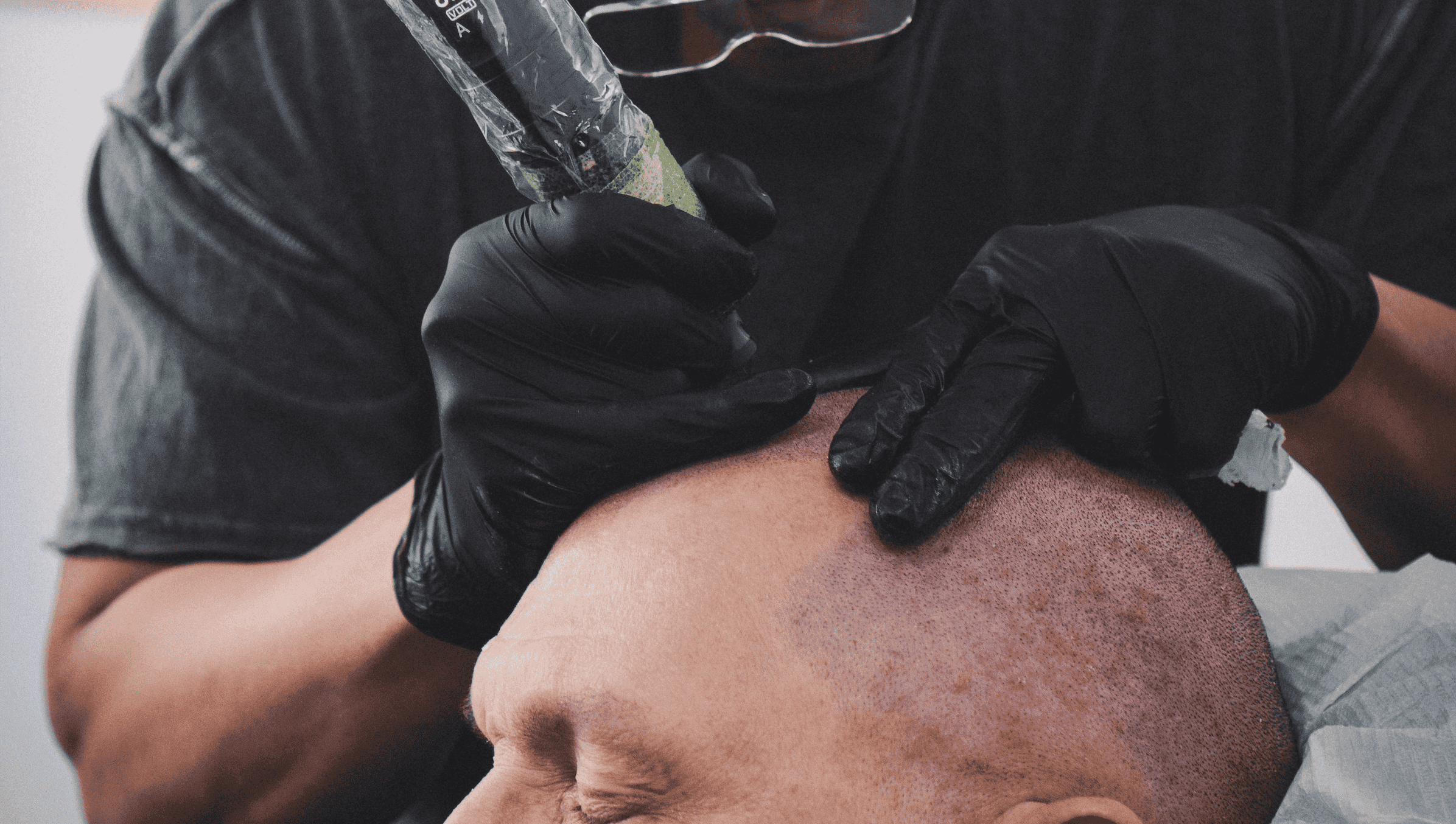 What Is a Hair Graft in a Hair Transplant?