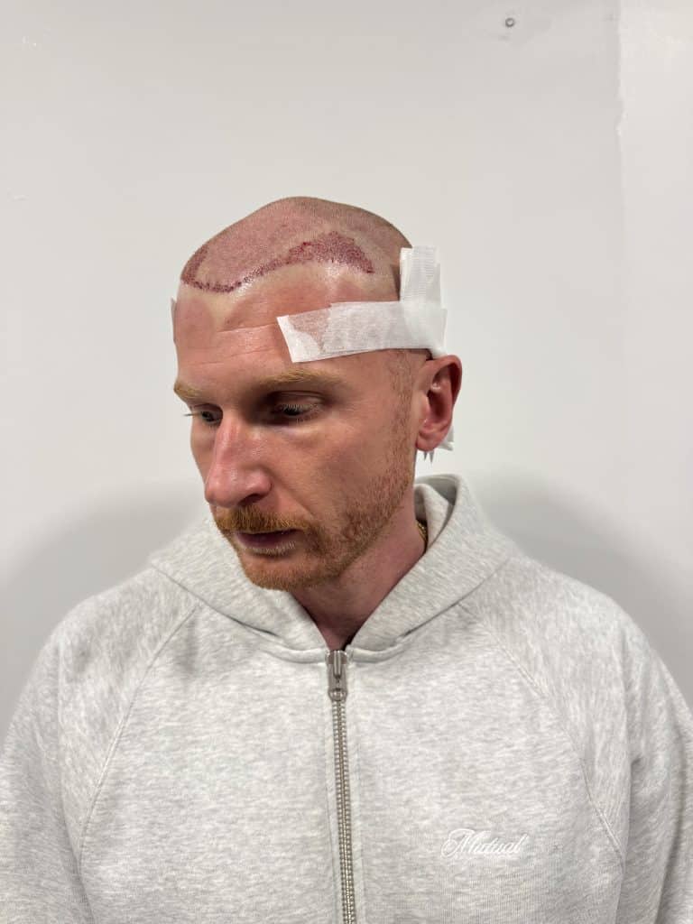Tom Maw Post op 1
