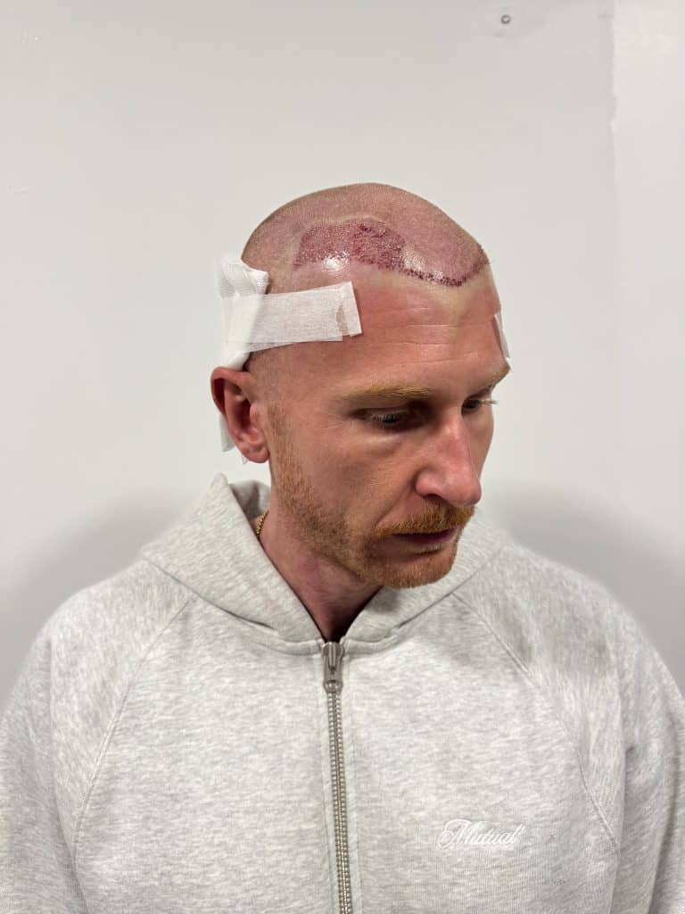 Tom Maw Post op 2