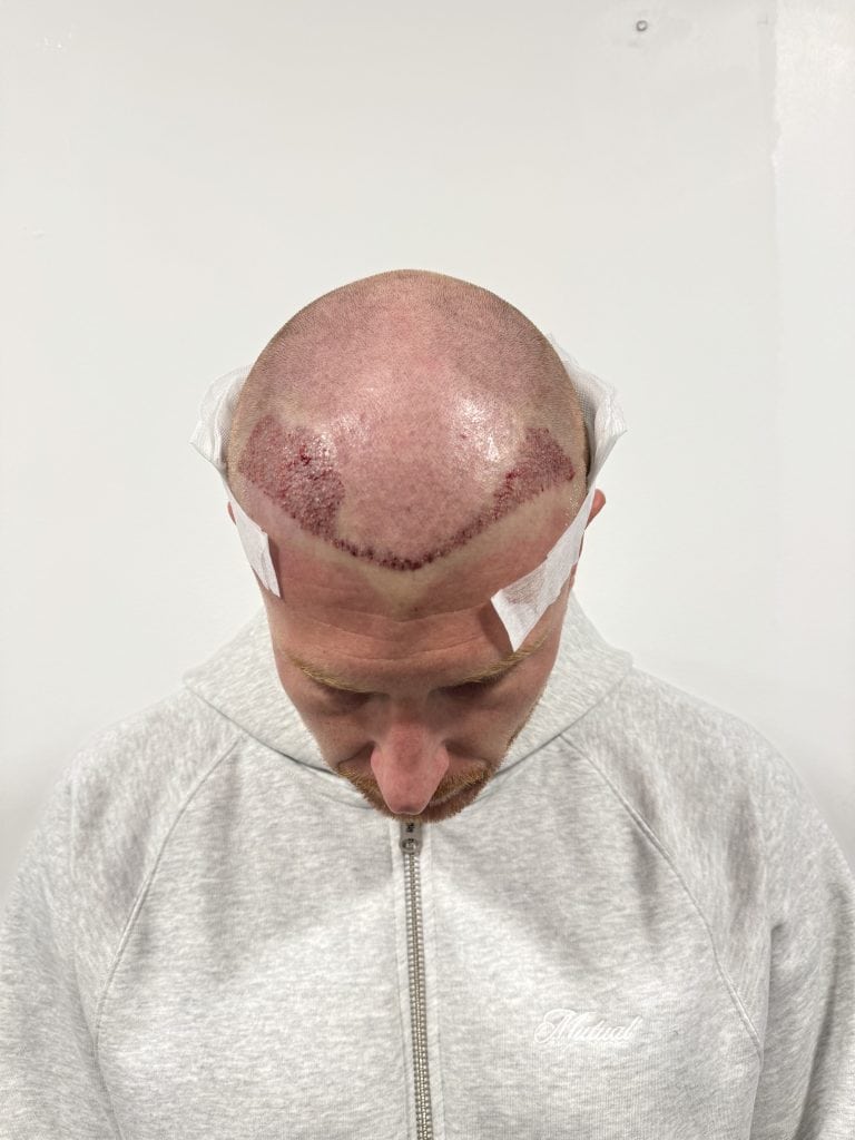 Tom Maw Post op 3