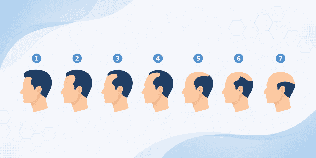 The Norwood Scale