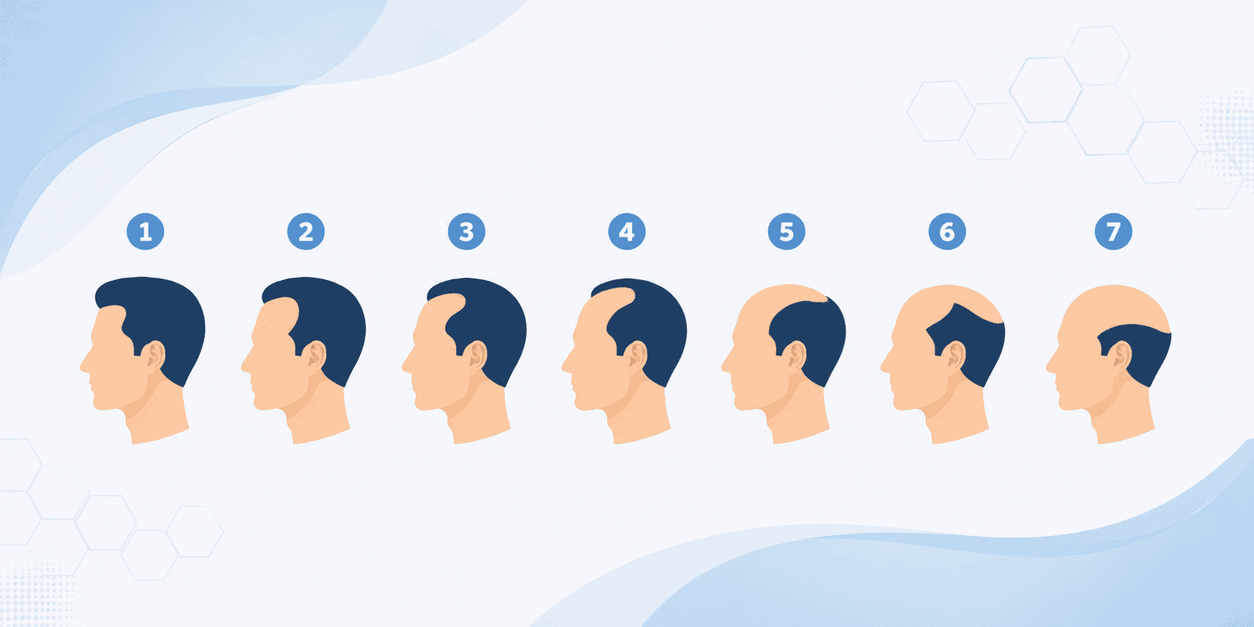 The Norwood Scale