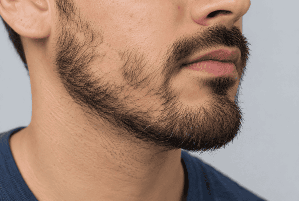 Bald Spot on Facial Hair
