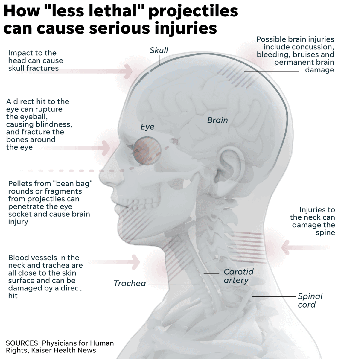 How less lethal projectiles can cause serious injuries.