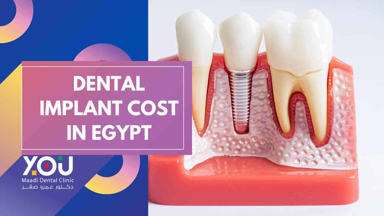 Cost of Dental Implants in Egypt : A Comprehensive Guide