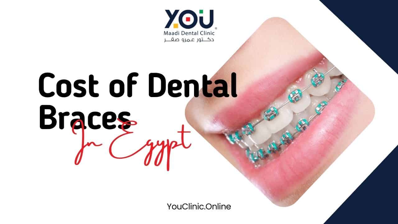 The Cost of Dental Braces in Egypt