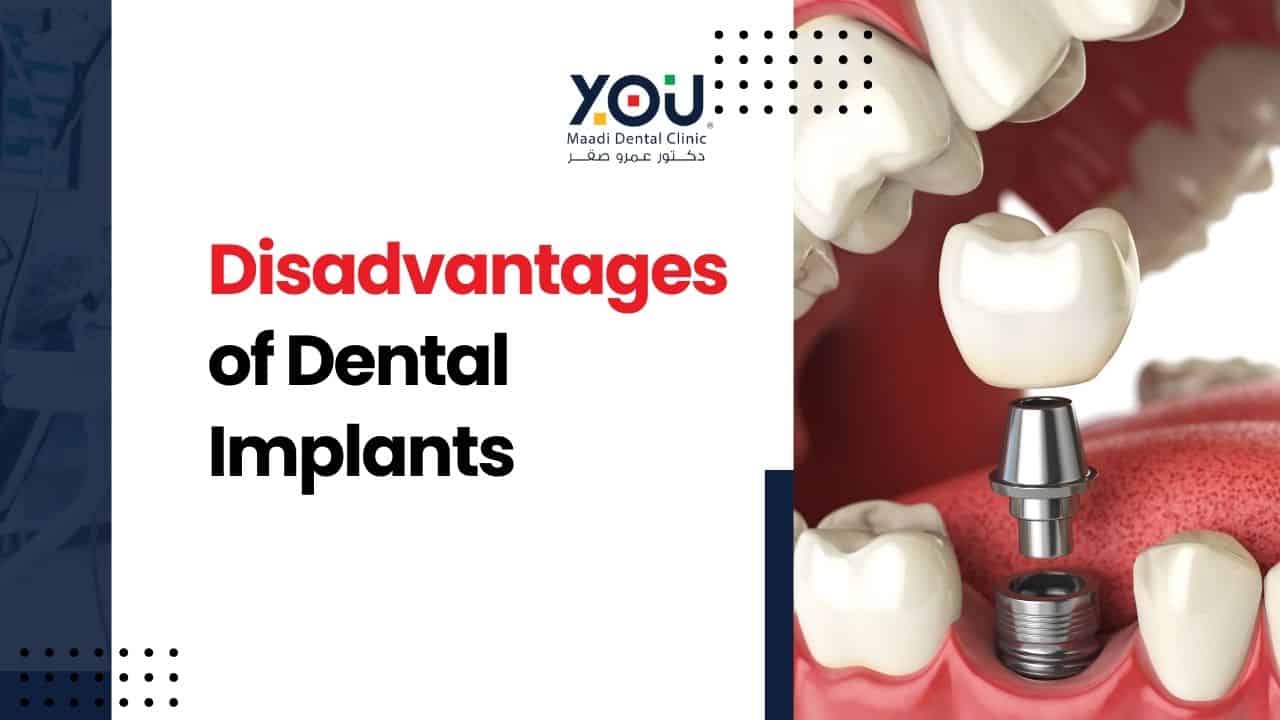 The Disadvantages of Dental Implants