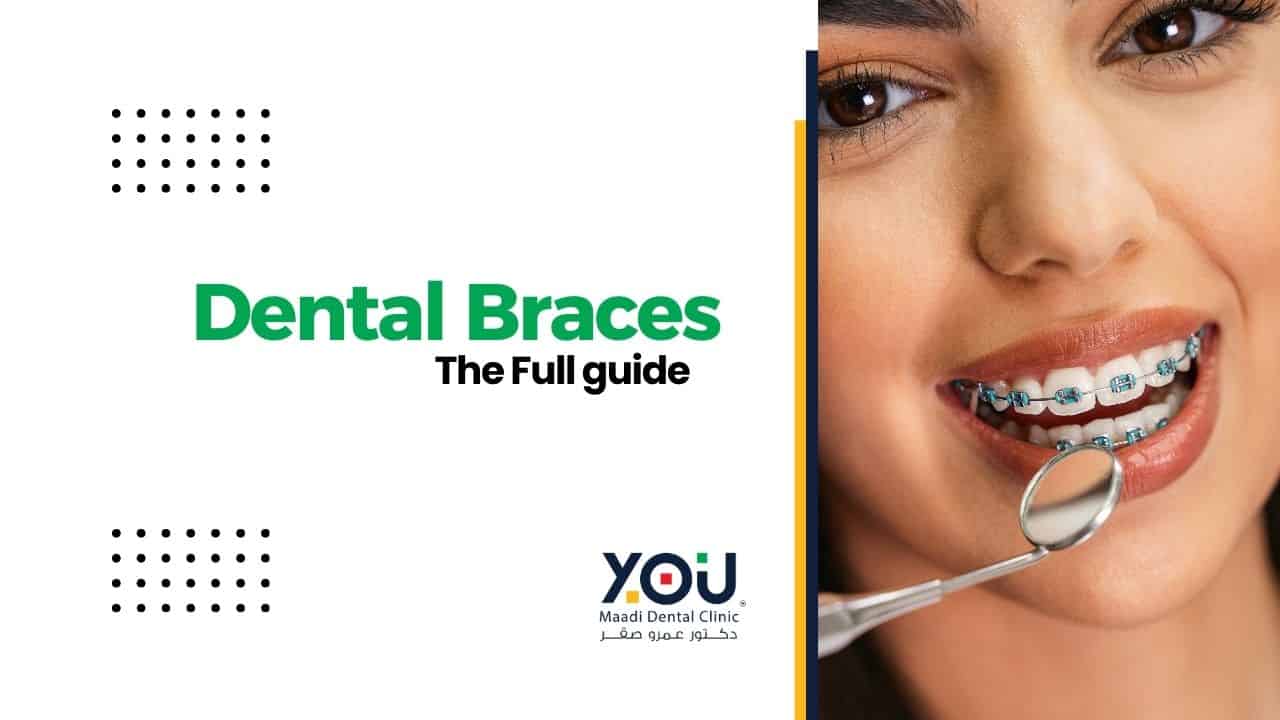 Dental Braces in Egypt: A Comprehensive Guide