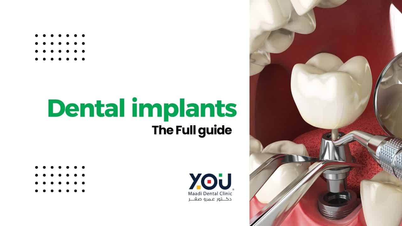 Dental Implants in Egypt: Full Guide By YOU Maadi Dental Clinic