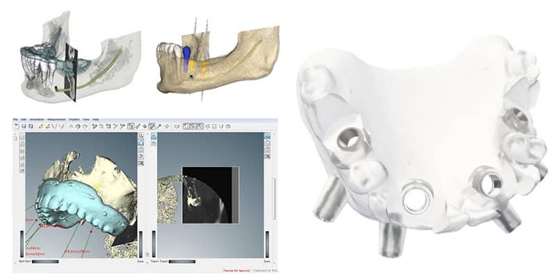 zirconia crown design, dental implant workflow, digital denture CAD design