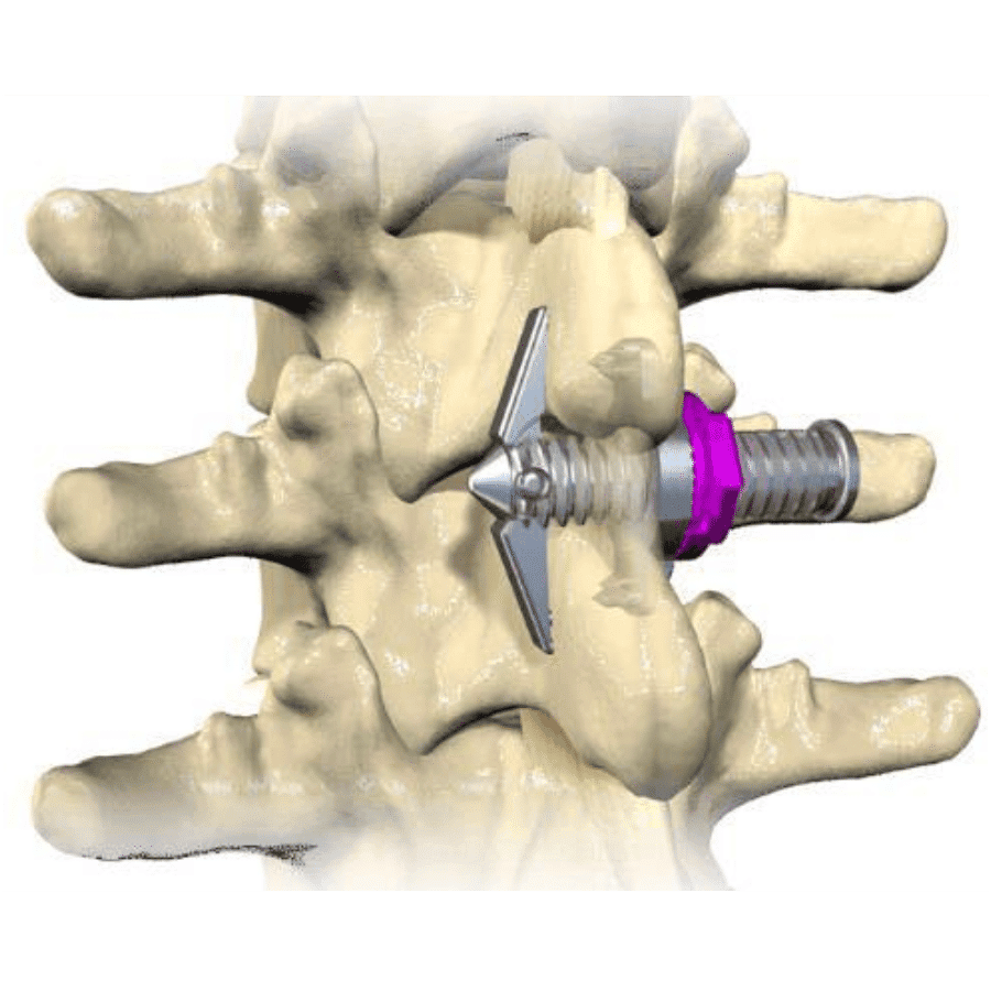 Minuteman Spine Fusion Physician | Dr Algendy | MA 02379
