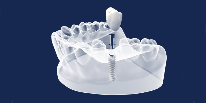 digital dental design occlusion workflow