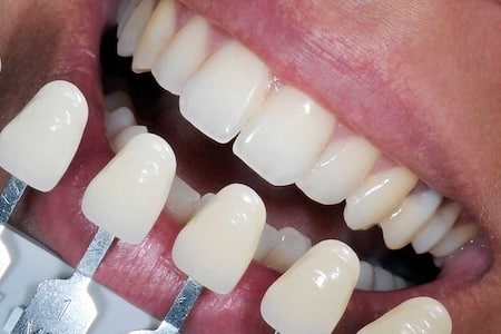 veneers