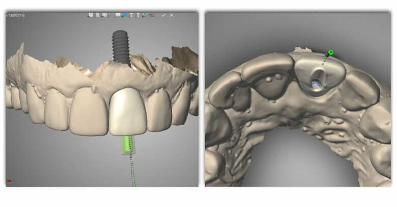 global dental outsourcing, VCAD Dental Lab Vietnam, digital dentistry trust