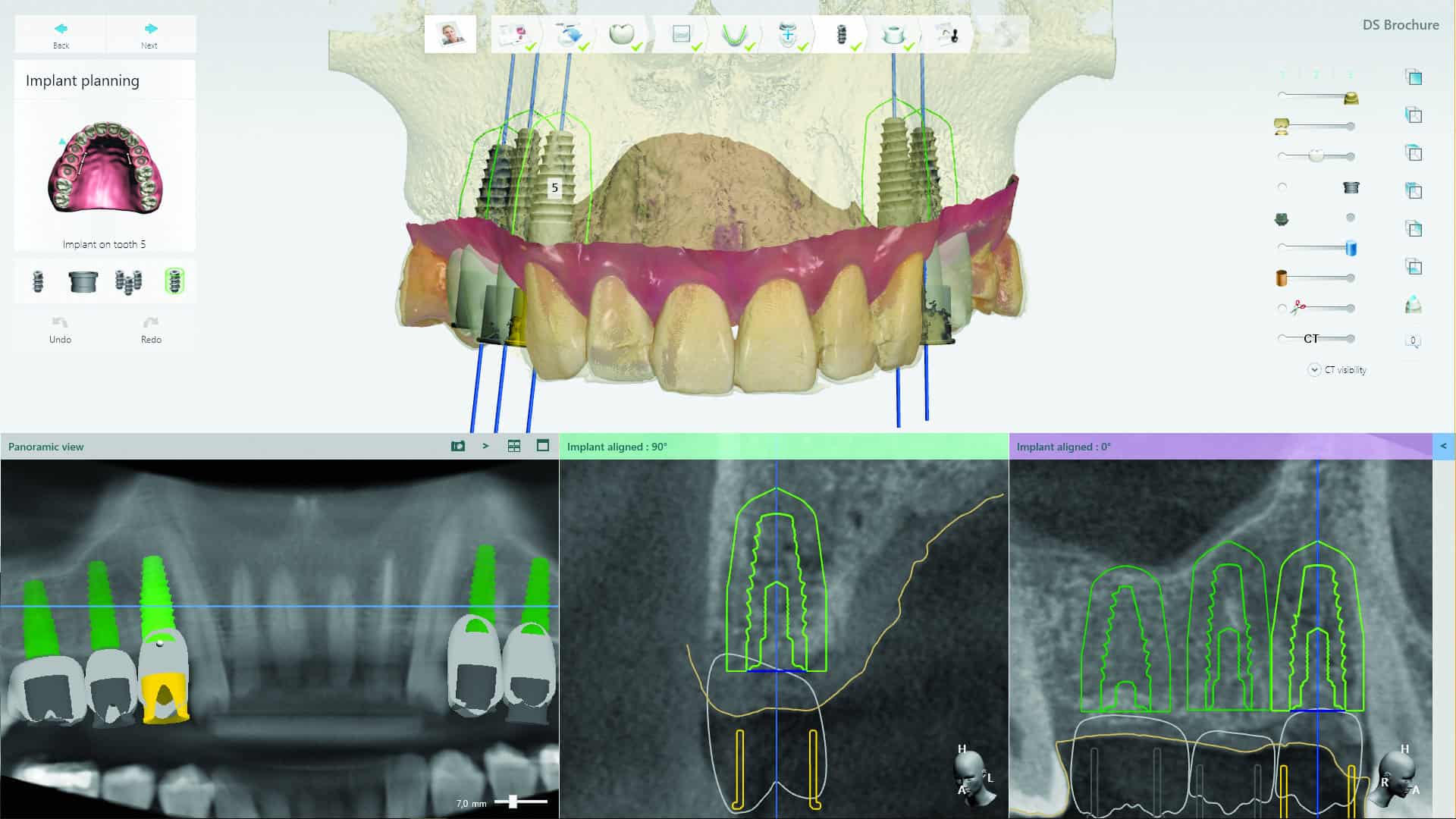 CAD Software - VCAD Dental