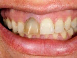 Whitening a Single Dark Tooth