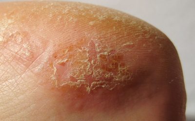 Kontaktdermatitis – ein Problem, viele Namen, zahlreiche Ursachen