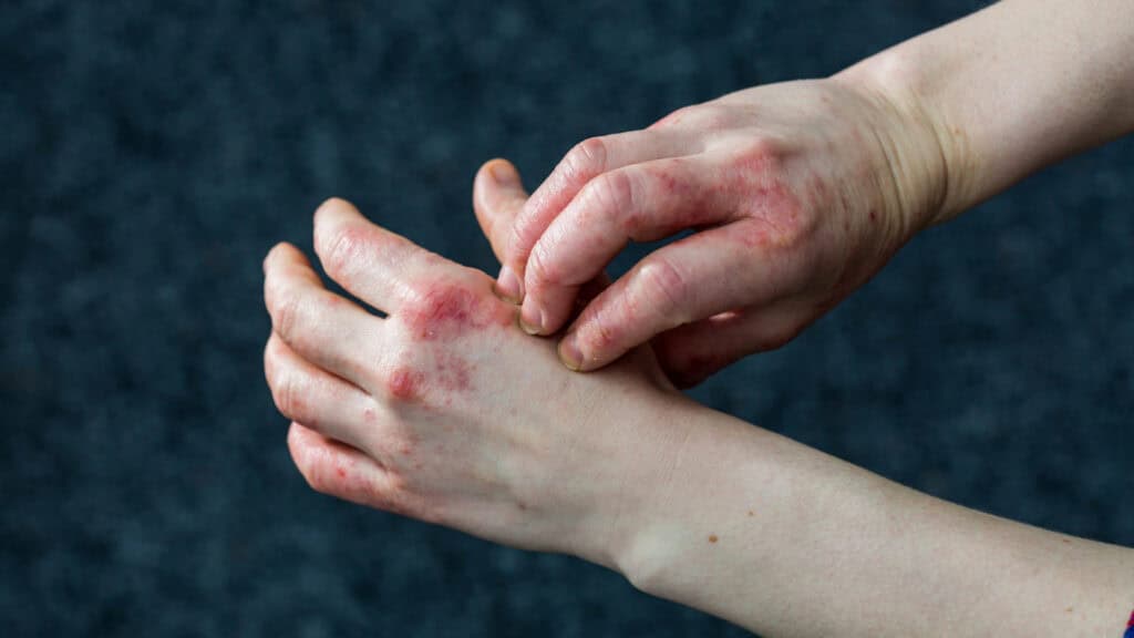 Patient with atopic dermatitis scratching hand eczema