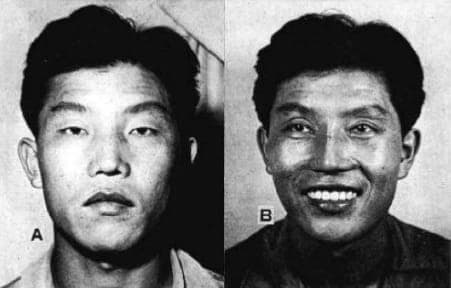 Split image of the same man; left side (A) shows him with a neutral expression, while right side (B) shows him smiling widely, revealing teeth. Black and white photo, labeled with letters A and B.