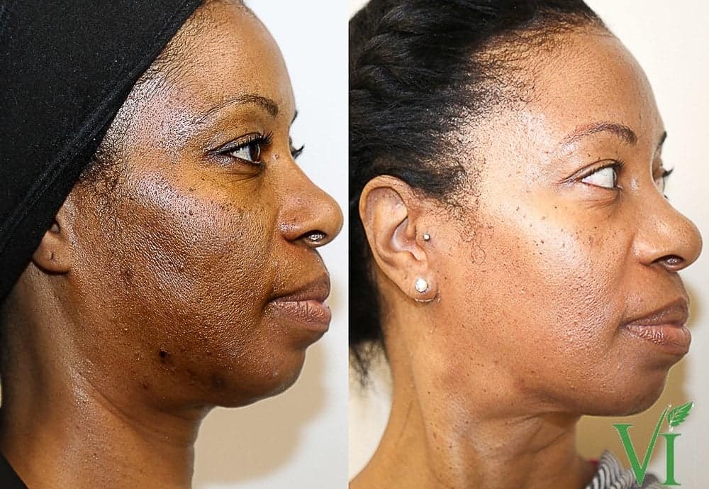 Chemical Peels - Before and After