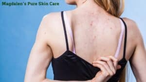 What is a Back Facial