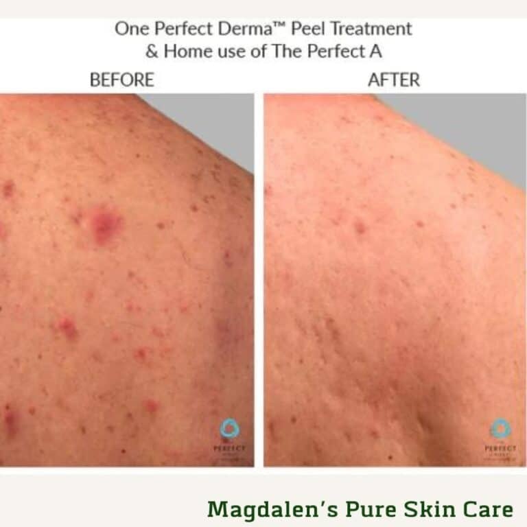 Back Acne Perfect Derma Peel™