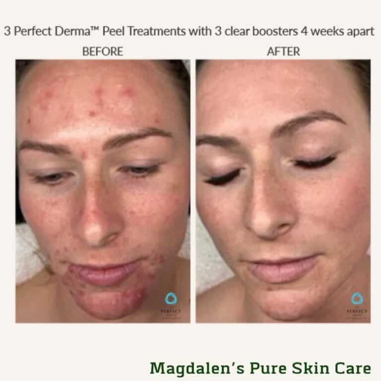 Before and After- perfect derma Peel™ with clear booster
