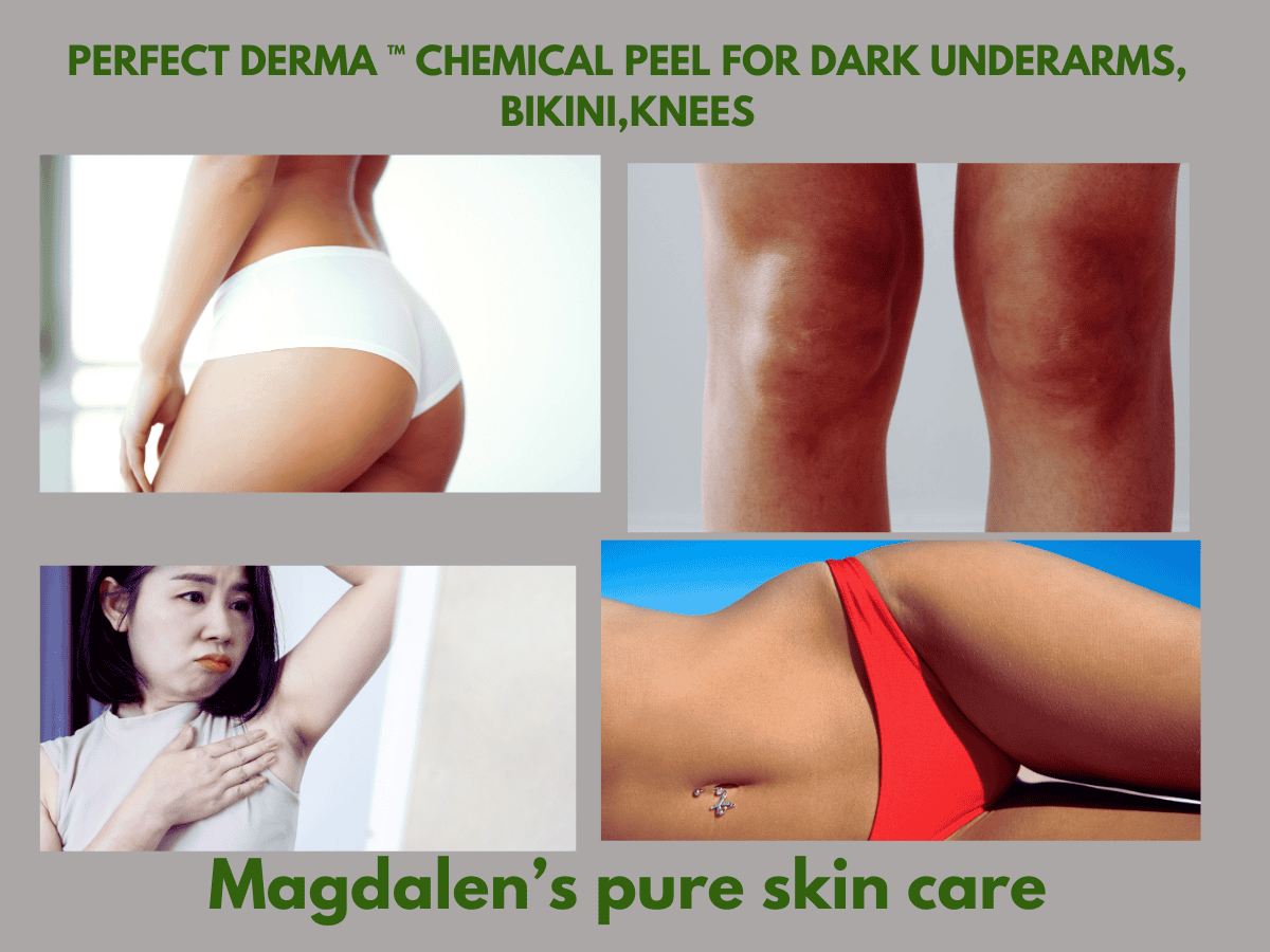 The Perfect Derma Peel in Rockville, MD 2 The Perfect Derma Peel in Rockville, MD
