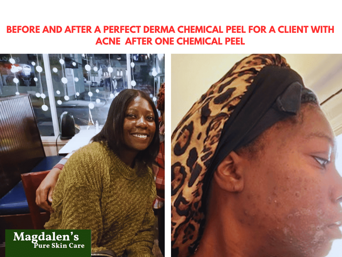 The Perfect Derma Peel in Rockville, MD