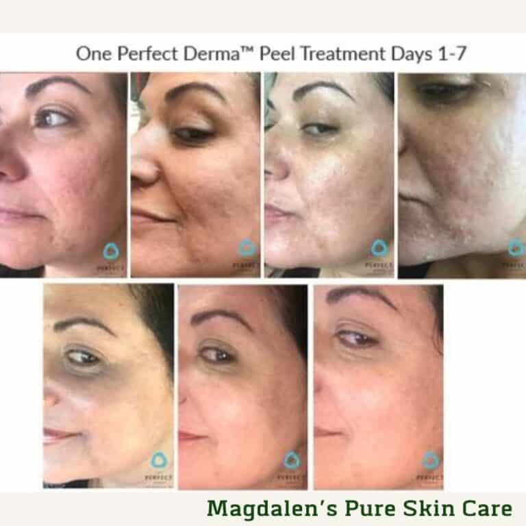Perfect derma Peel™ treatment with heavy peeling