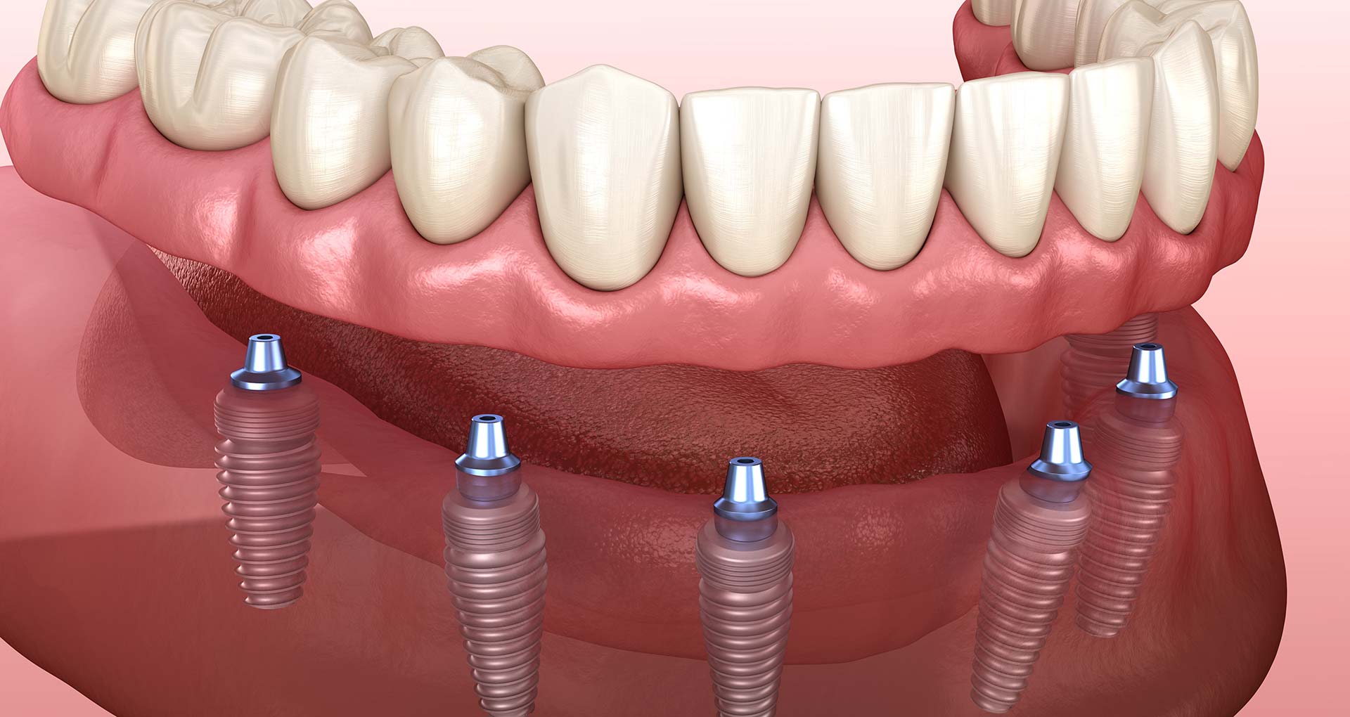 Full-Arch Dental Implant Procedure - Dental Implants In One Day and One ...