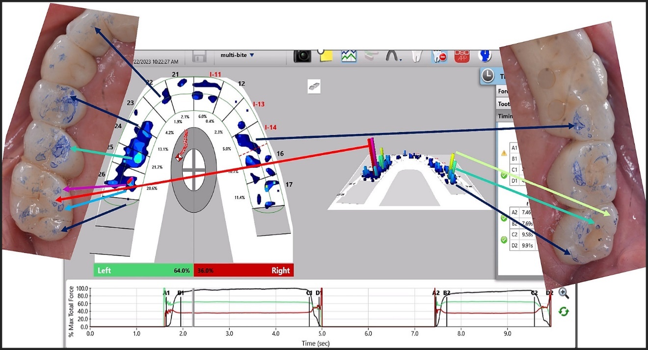 digital dental occlusion design software heatmap