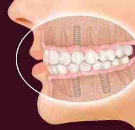 Impianto dentale fisso in titanio su modello d'arcata dello Studio Dentistico a Lucca Del Bianco