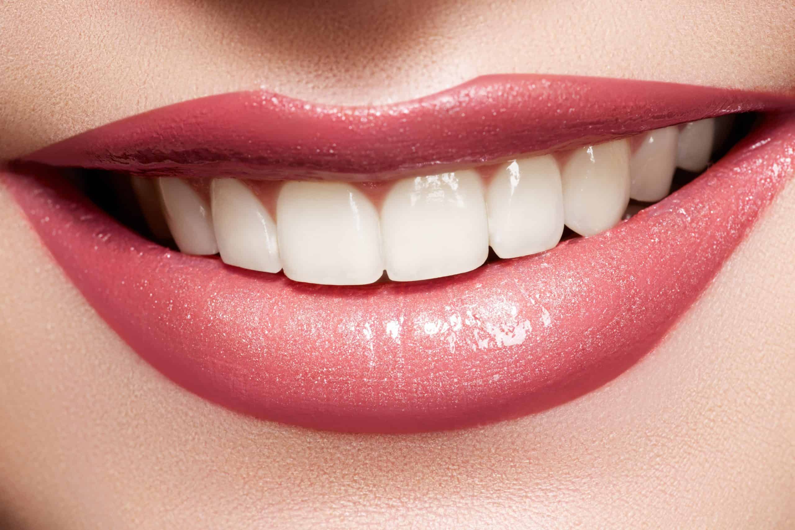 Allineare i denti