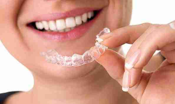 Allineatori dentali trasparenti e invisibili per l'ortodonzia - Studio dentistico Del Bianco