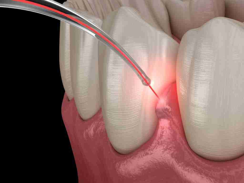 Laser Odontoiatrico a Lucca