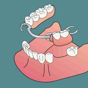 Riabilitazione estetica del sorriso con protesi dentale Studio Dentistico a Lucca Del Bianco.