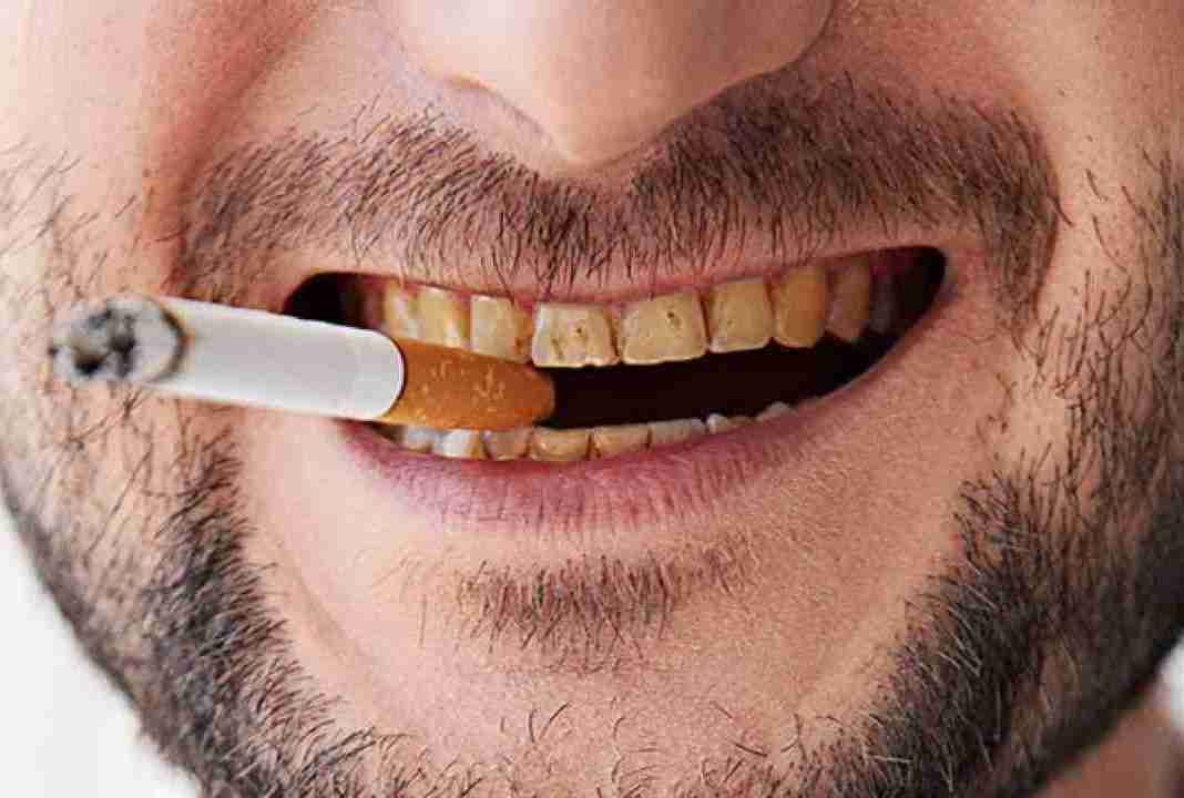 denti macchiati
