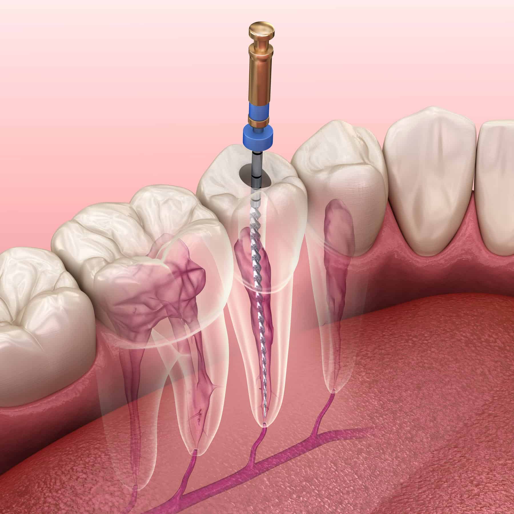 Trattamento di endodonzia e cura canalare presso lo Studio Dentistico Del Bianco
