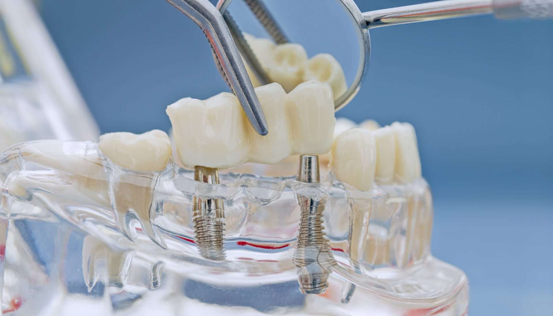 Mese Della Prevenzione Dentale