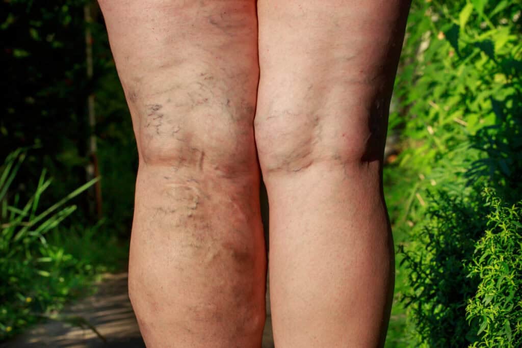 the disease varicose veins on a pair of male legs. He is standing on a sidewalk in between bushes.