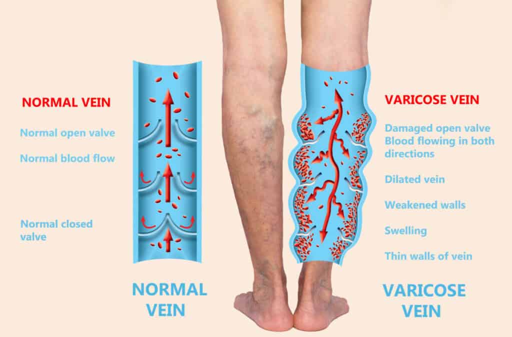 Varicose veins on a female senior bodybuilders legs. The structure of normal and varicose veins. Concept of dry skin, old senior people, varicose veins and deep vein thrombosis or DVT