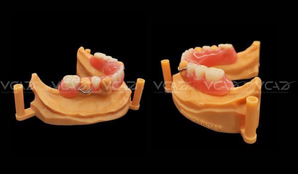 Case Study: Partial Denture - Shannon Walker