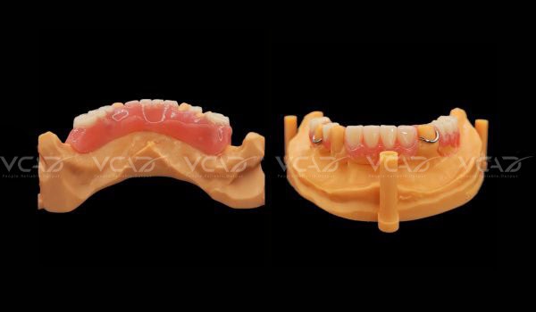 Case Study: Partial Denture - Shannon Walker