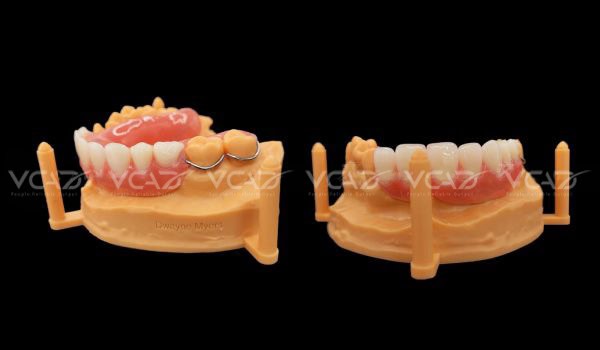 Case study Partial Upper Denture - Dwayne Myers